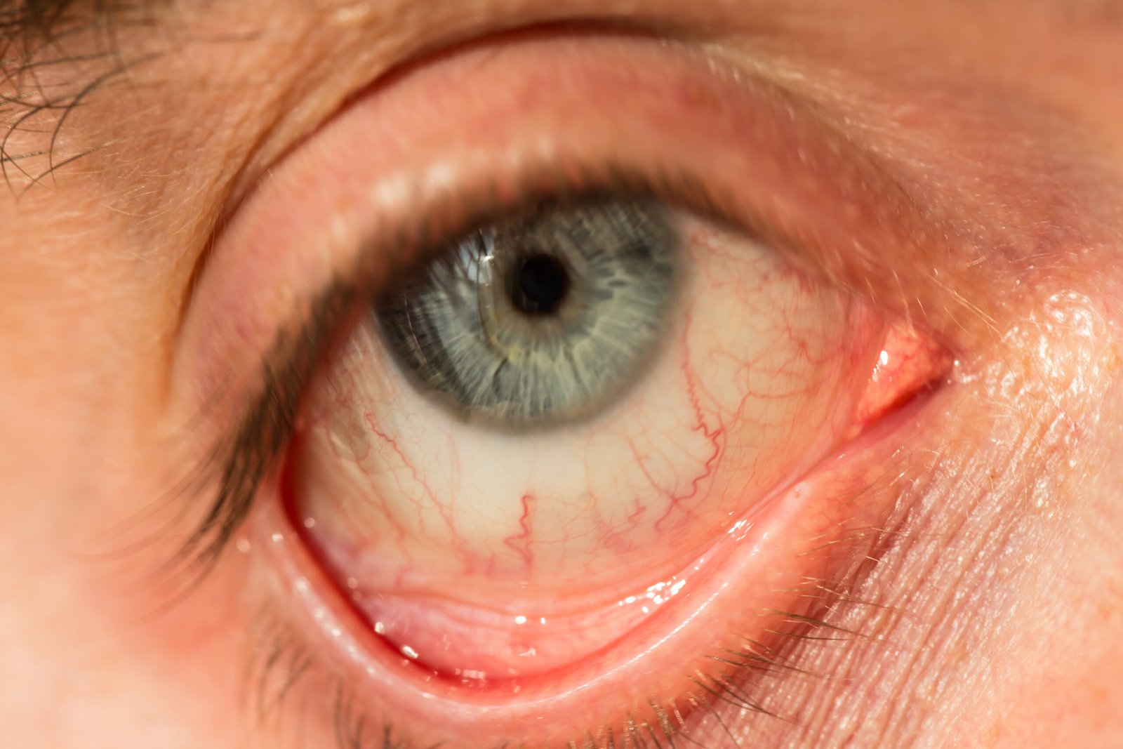 pole-ophtalmologie-colombes-la-defense photo d'un oeil présentant un ectropion avant une chirurgie de la paupière