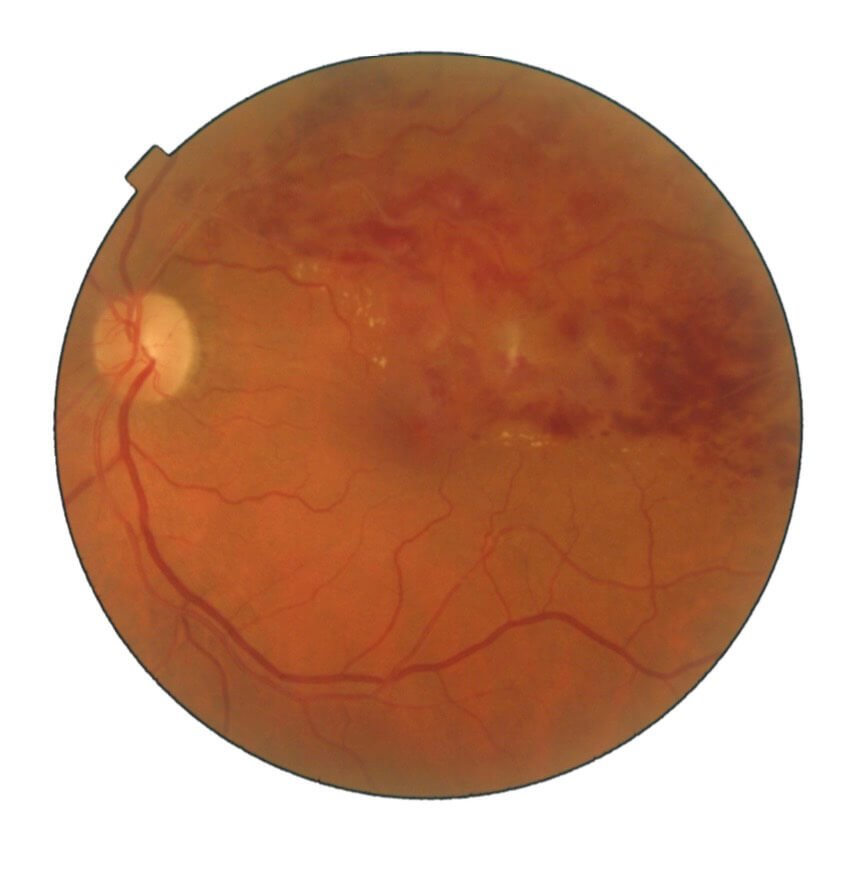 occlusion-veineuse-retinienne-colombes imagerie de la rétine montrant une occlusion veineuse rétinienne