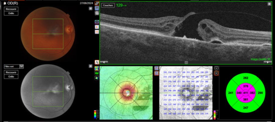 pole-ophtalmologie-colombes-la-defense ésultats d'examen ophtalmologique dans le cadre du suivi d'un trou maculaire